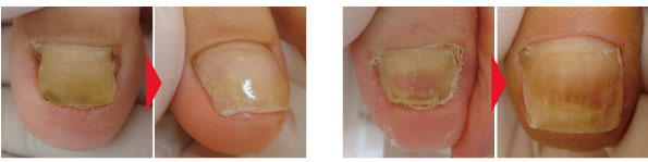 ペディグラステクノロジー ｜ 技術を学びたい方 コース紹介 ネイルリストア