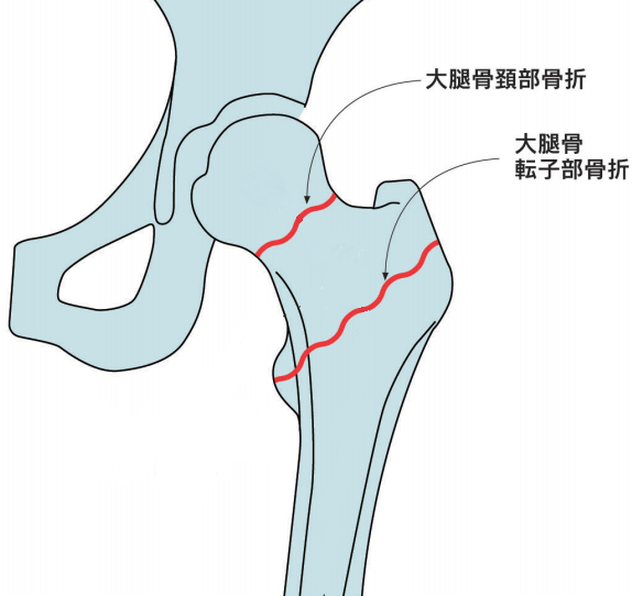 大腿骨近位部骨折（頚部骨折と転子部骨折）の治療について／西脇病院