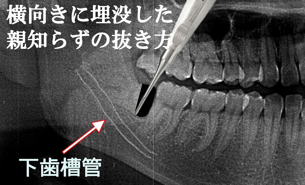 横向きに埋まった親知らずの抜き方とは？難症例にも対応した抜歯の手順