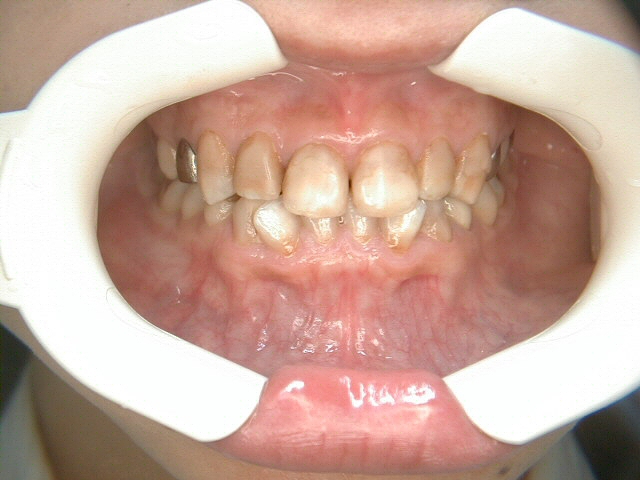 審美歯科治療 あい歯科医院 長野県松本市南原の歯科医院,審美歯科