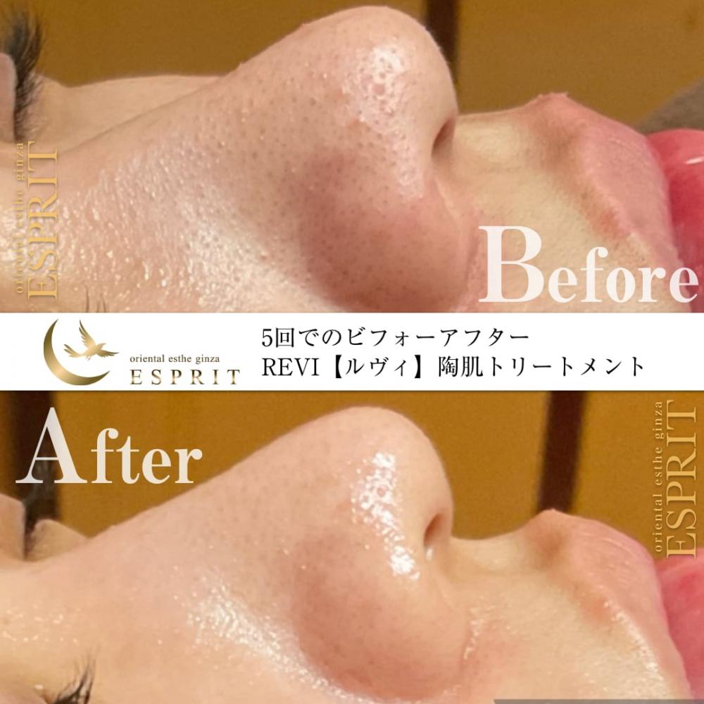 ハーブピーリングREVI【ルヴィ】陶肌トリートメント ｜東京銀座、新宿