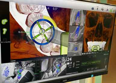 インプラント手術ナビゲーションシステムX-ガイド | 五十嵐歯科医院