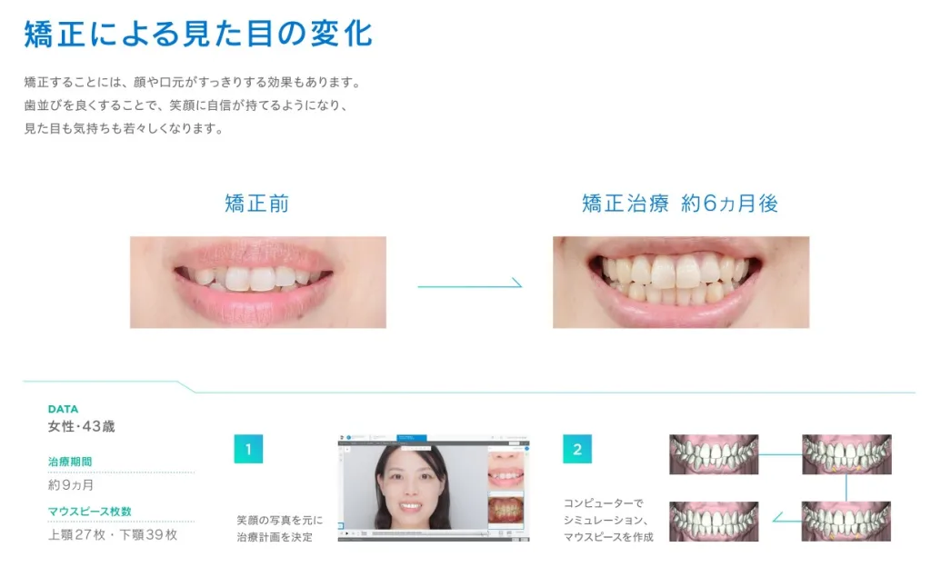 シュアスマイルマウスピース矯正