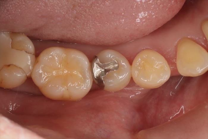 右下第二小臼歯の金属を除去してセラミック修復しました。2025.05.14