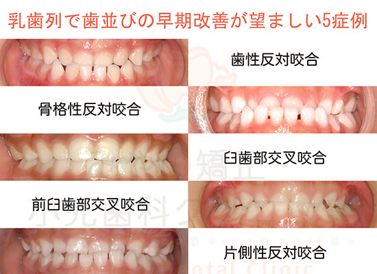子供の矯正治療｜茨木市の歯医者（歯科医院）「みやの矯正・小児歯科
