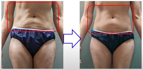 マッコイ | ノンFシェイプEX G 専用容器つき