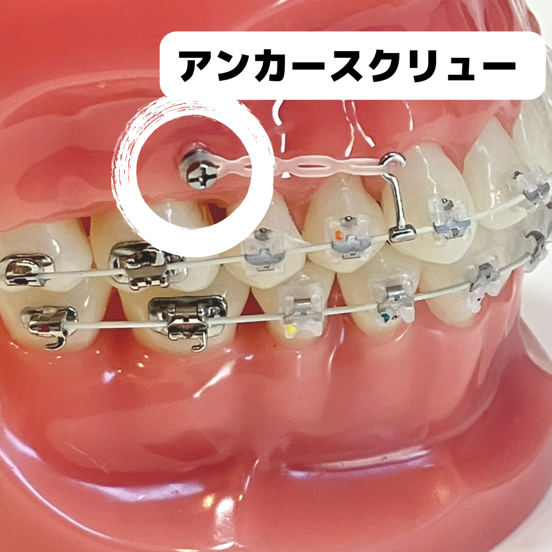 矯正のネジは痛い？必要な人は【アンカースクリュー（TAD） 】 - 尼崎