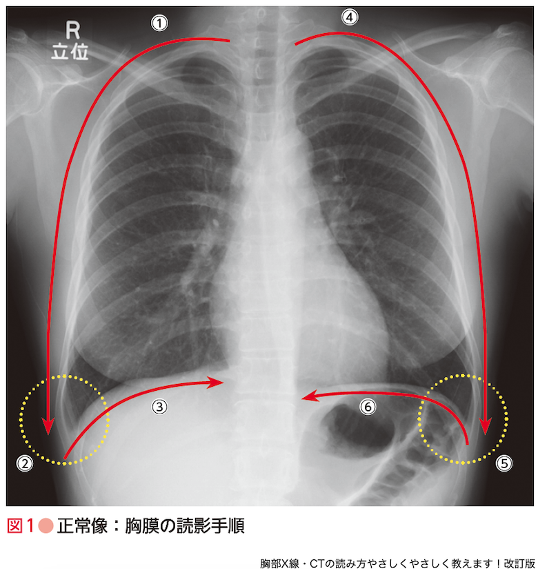 胸部X線・CTの読み方やさしくやさしく教えます！改訂版 - 羊土社