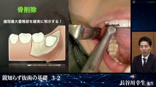 埋伏歯抜歯を武器にする！親知らず抜歯の基礎 | Doctorbook academy