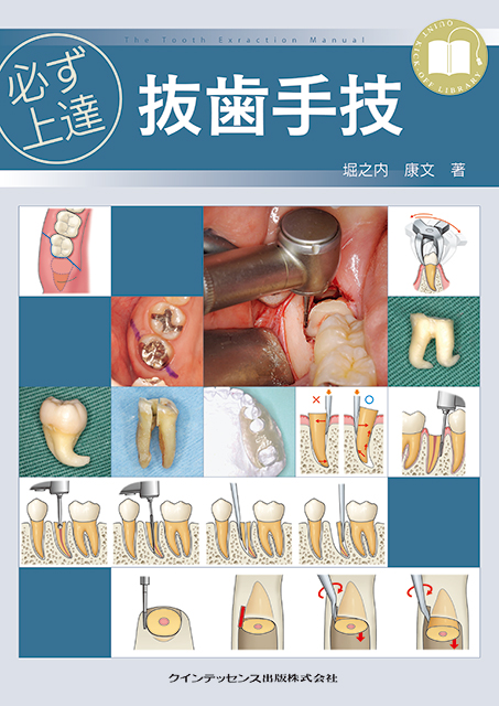 智歯の抜歯ナビゲーション - クインテッセンス出版