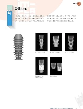 続・このインプラントなに? 他医院で治療されたインプラントへの対応