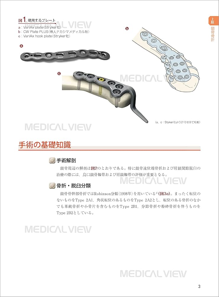 骨折 プレート治療マイスター−改訂第2版 | 澤口 毅 |本 | 通販 | Amazon