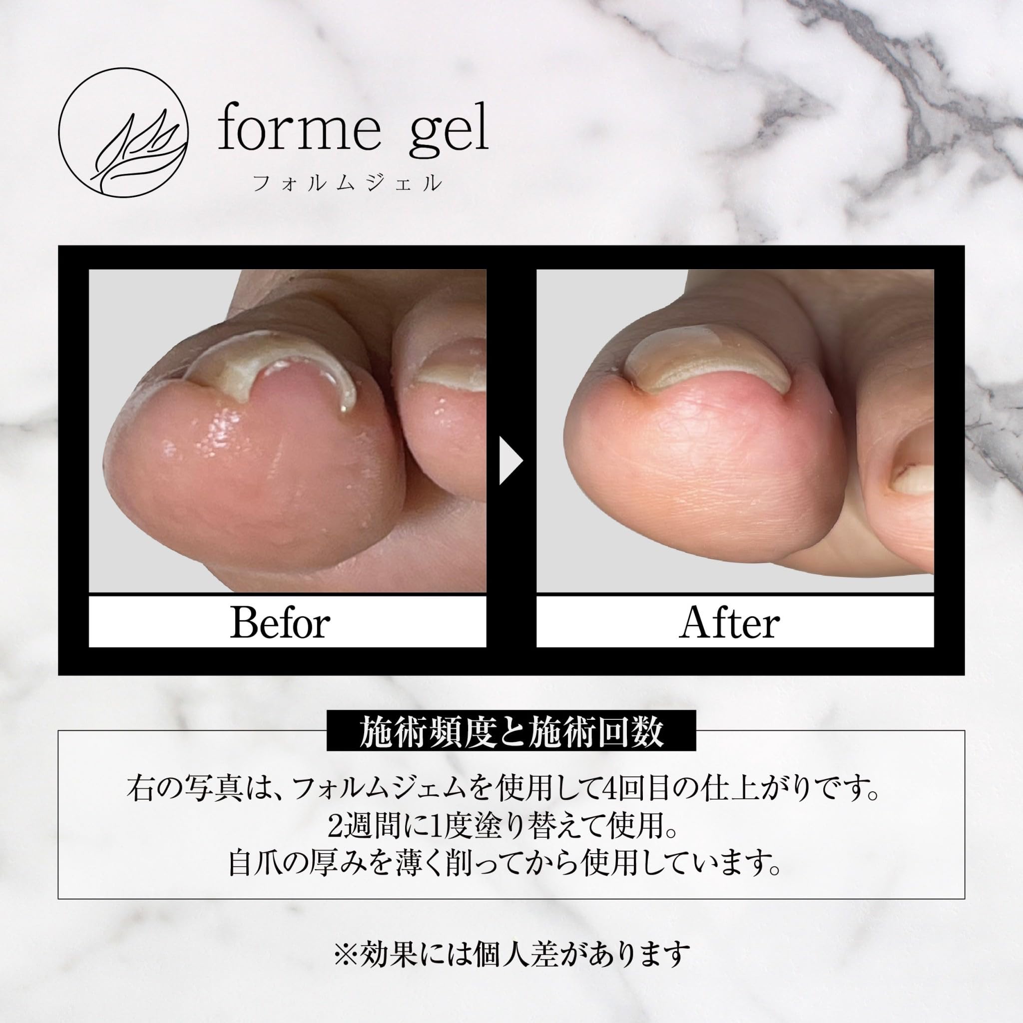 Amazon | フォルムジェル 誰でも簡単！塗るだけ！巻き爪ケアジェル
