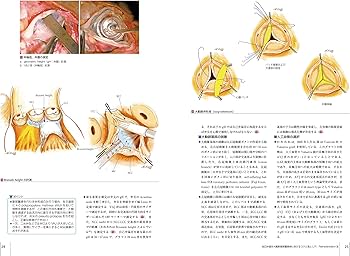 大動脈疾患の手術 (心臓血管外科手術エクセレンス) | 長田信洋, 大北