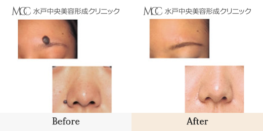 ほくろ切開除去-茨城県 水戸中央美容形成クリニック