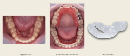 矯正終了後に使うリテーナー（保定装置）について | 荻窪ツイン歯科