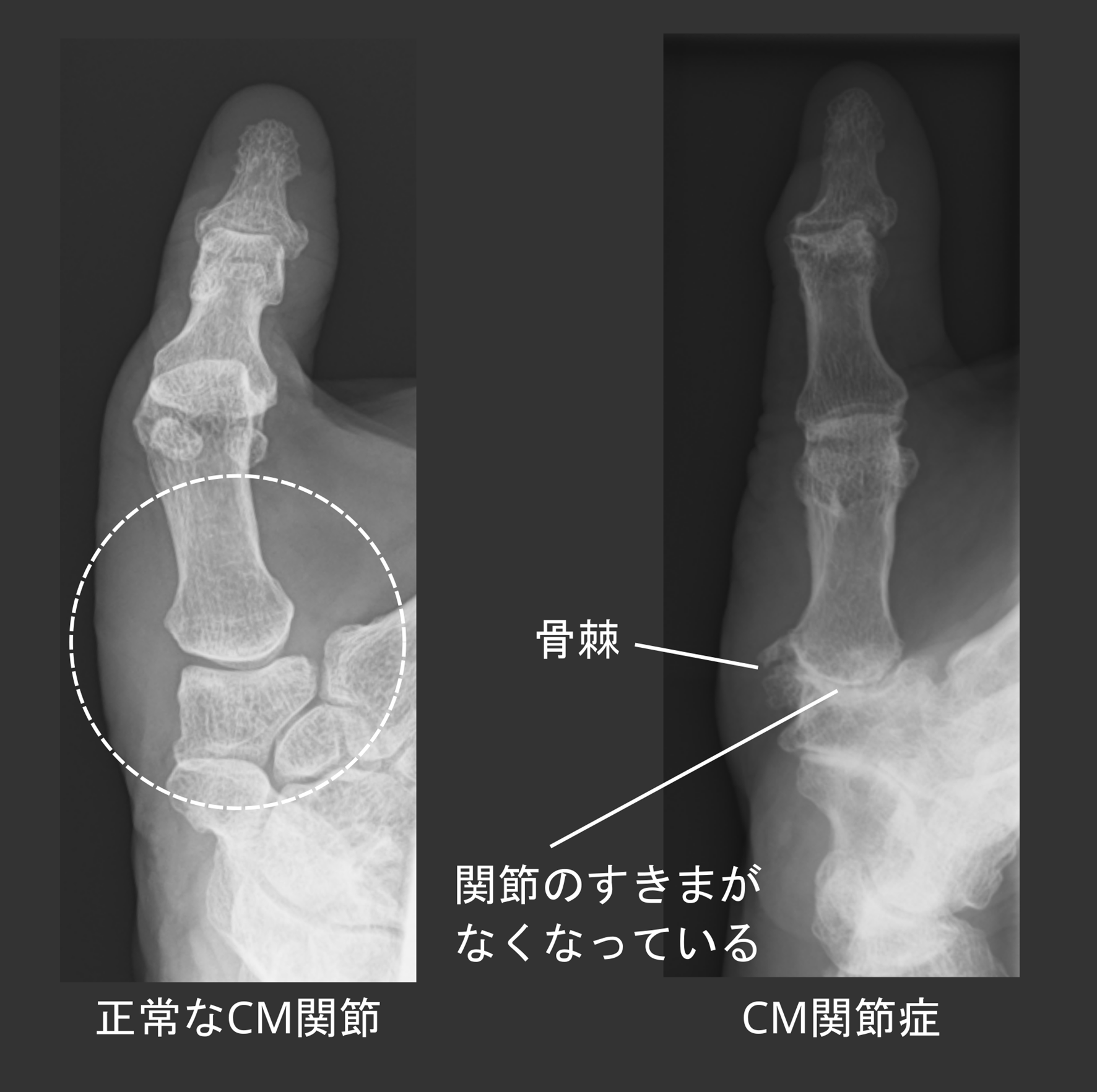 手外科・肘の外科について - 大阪けいさつ病院｜大阪国際メディカル