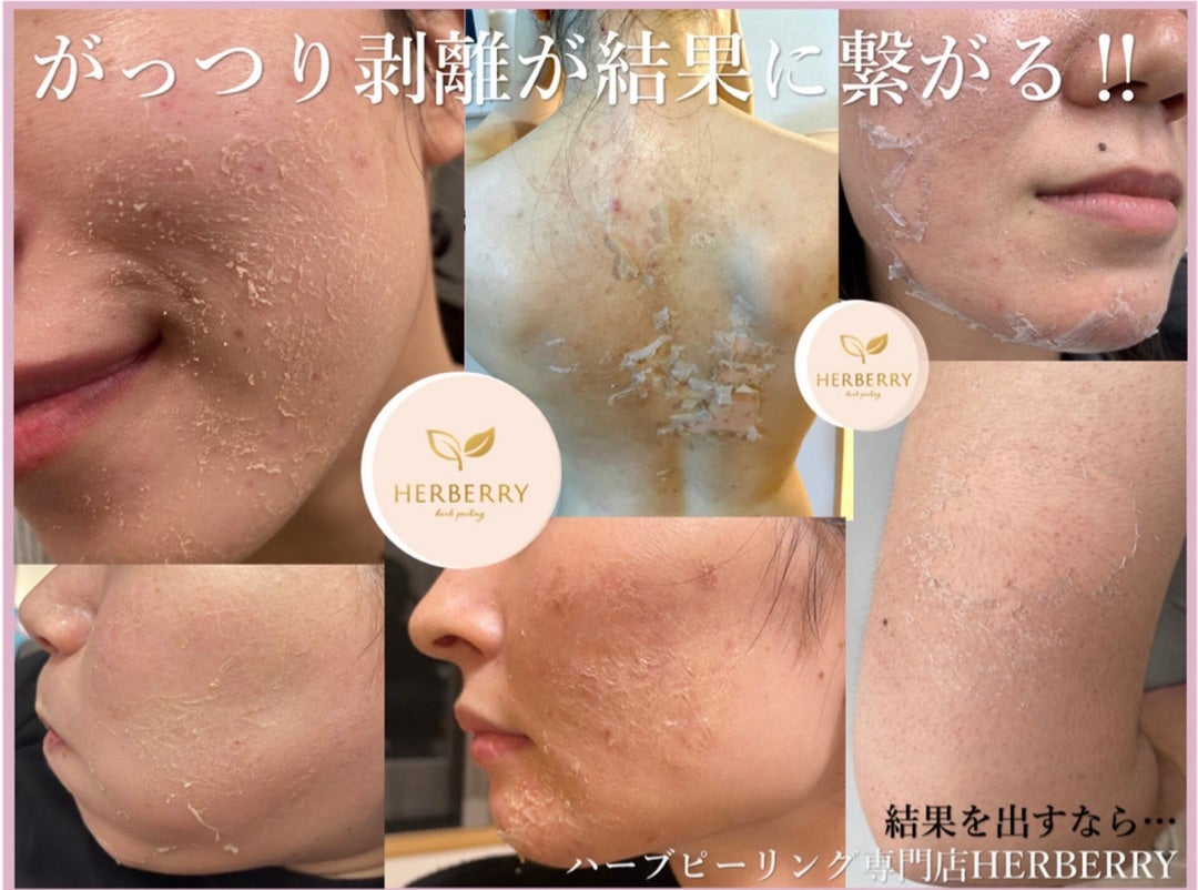 最速＆最強の肌治療→剥離ありハーブピーリング！ | ハーブピーリング