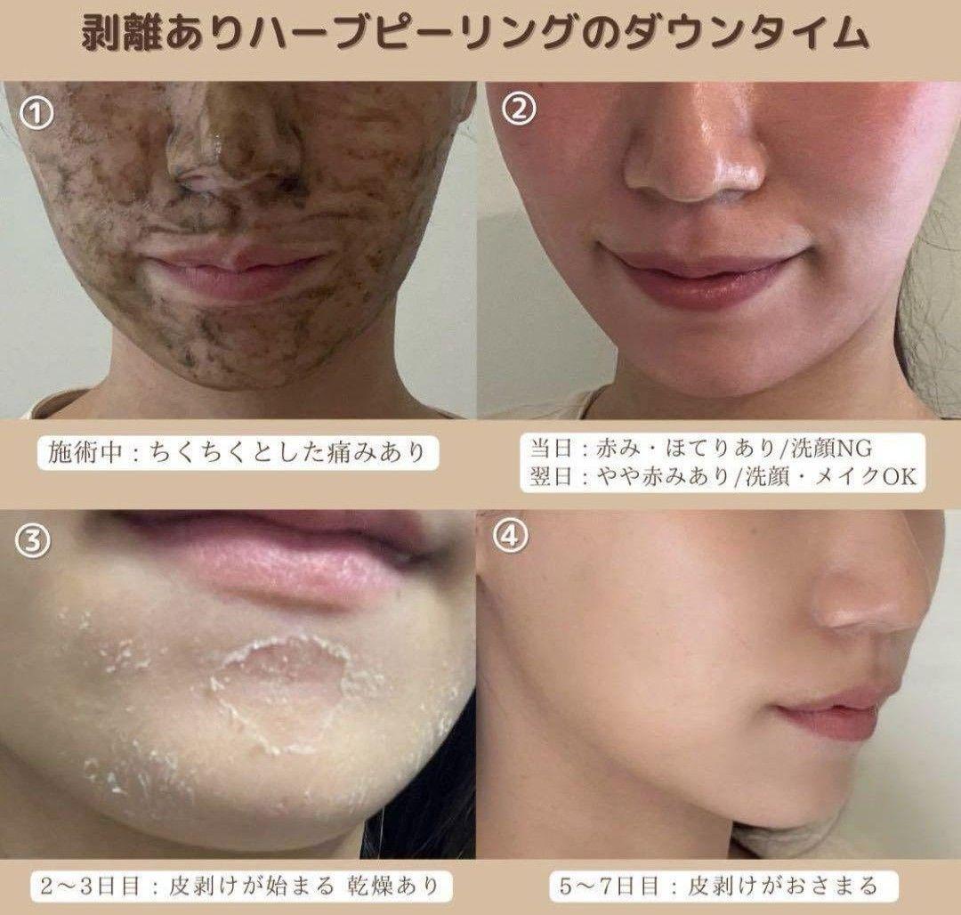 剥離ありハーブピーリング - メルカリ