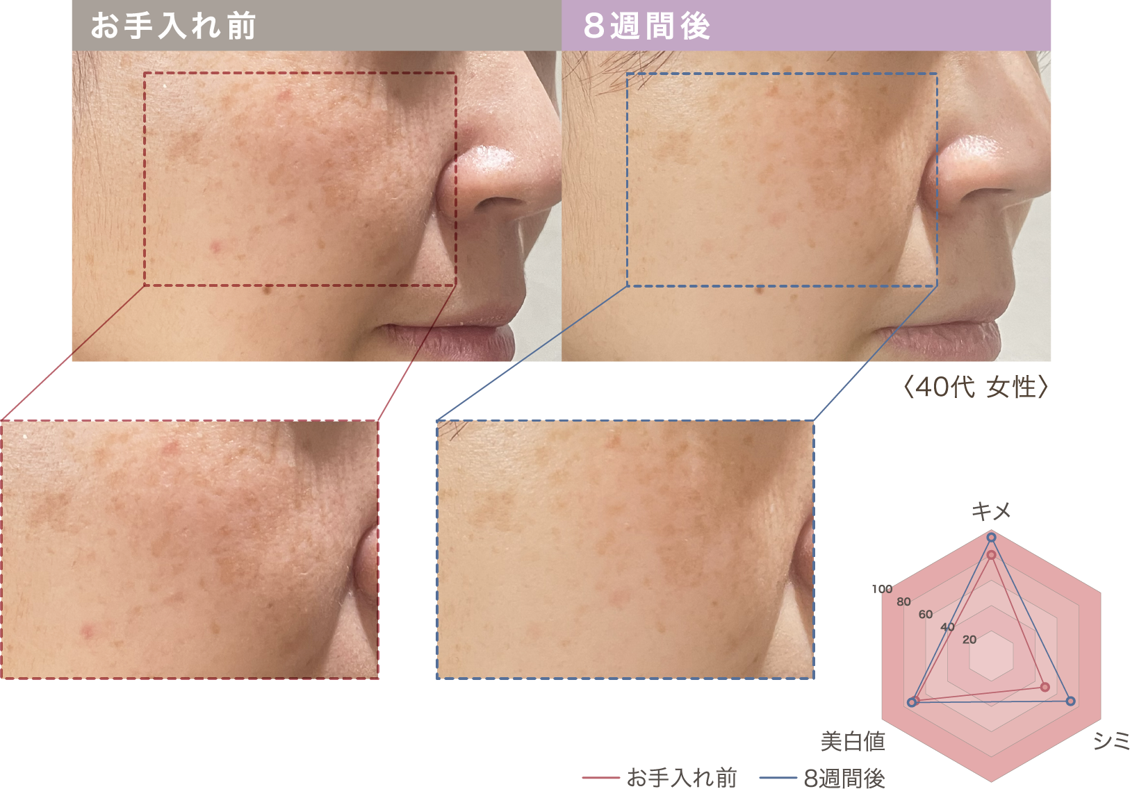 LINKA スノーフラッシュ（光エイジングケア美顔器）