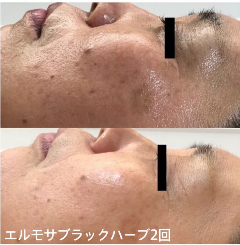 年齢肌ハーブピーリング | コトハのホームページ