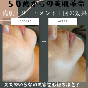 ハーブピーリング｜REVI陶肌トリートメントの導入費用、効果・口コミ